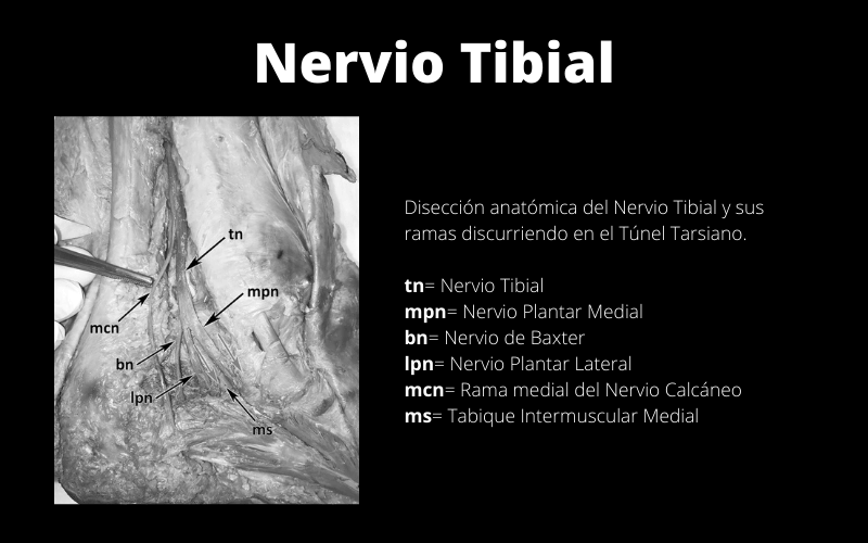 Nervio Tibial 2.png